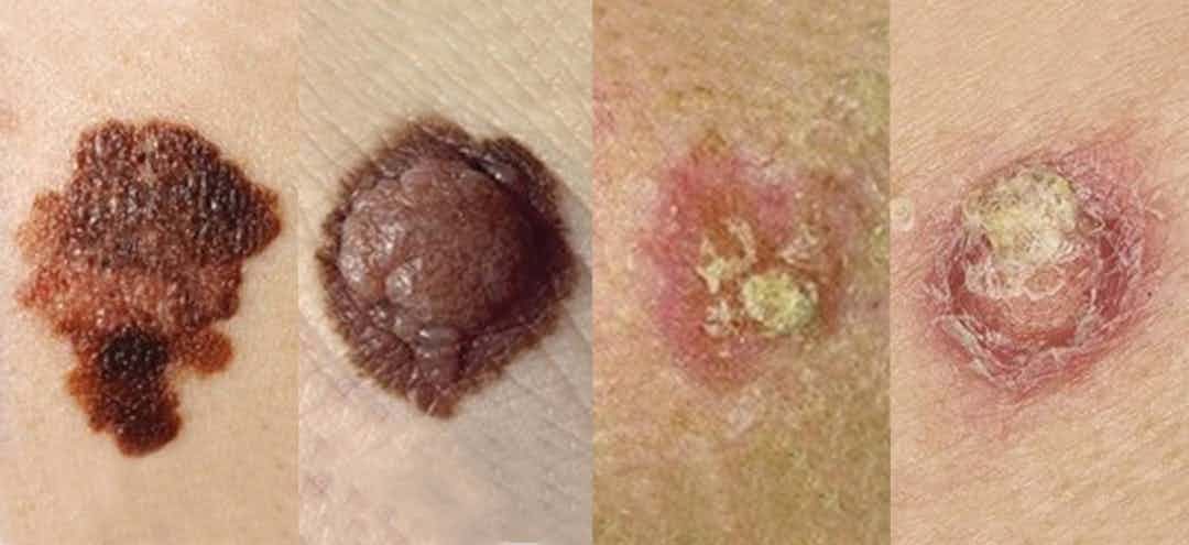 A comparison of different skin cancer moles